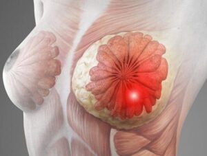 Breast Reconstruction