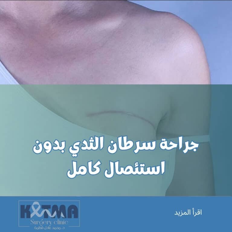 جراحة سرطان الثدي بدون استئصال كامل