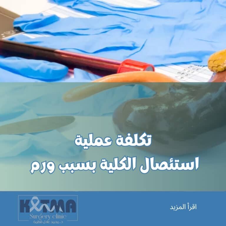 تكلفة عملية استئصال الكلية بسبب ورم