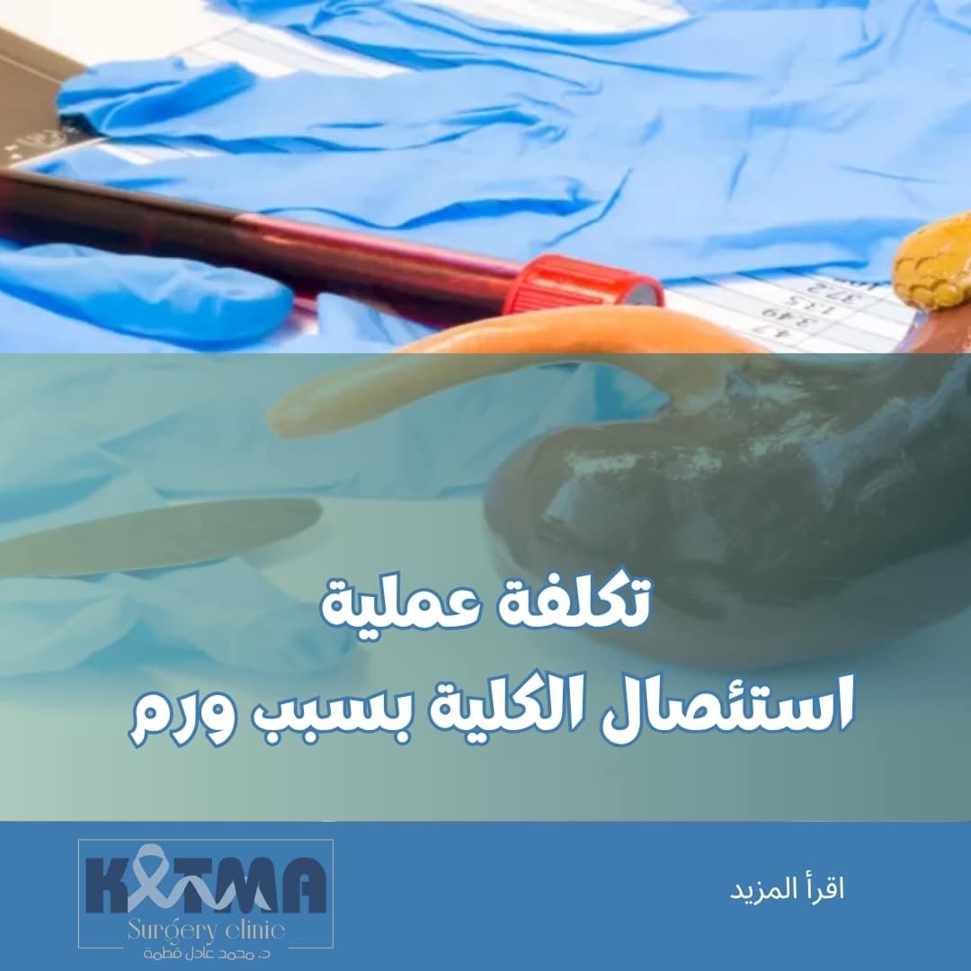 تكلفة عملية استئصال الكلية بسبب ورم