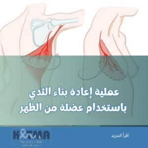 عملية إعادة بناء الثدي باستخدام عضلة من الظهر
