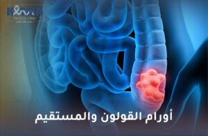 أورام القولون والمستقيم