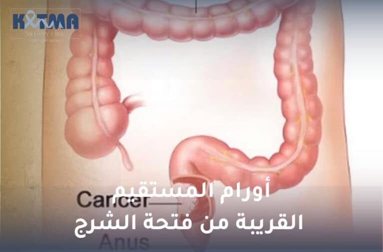 أورام المستقيم القريبة من فتحة الشرج