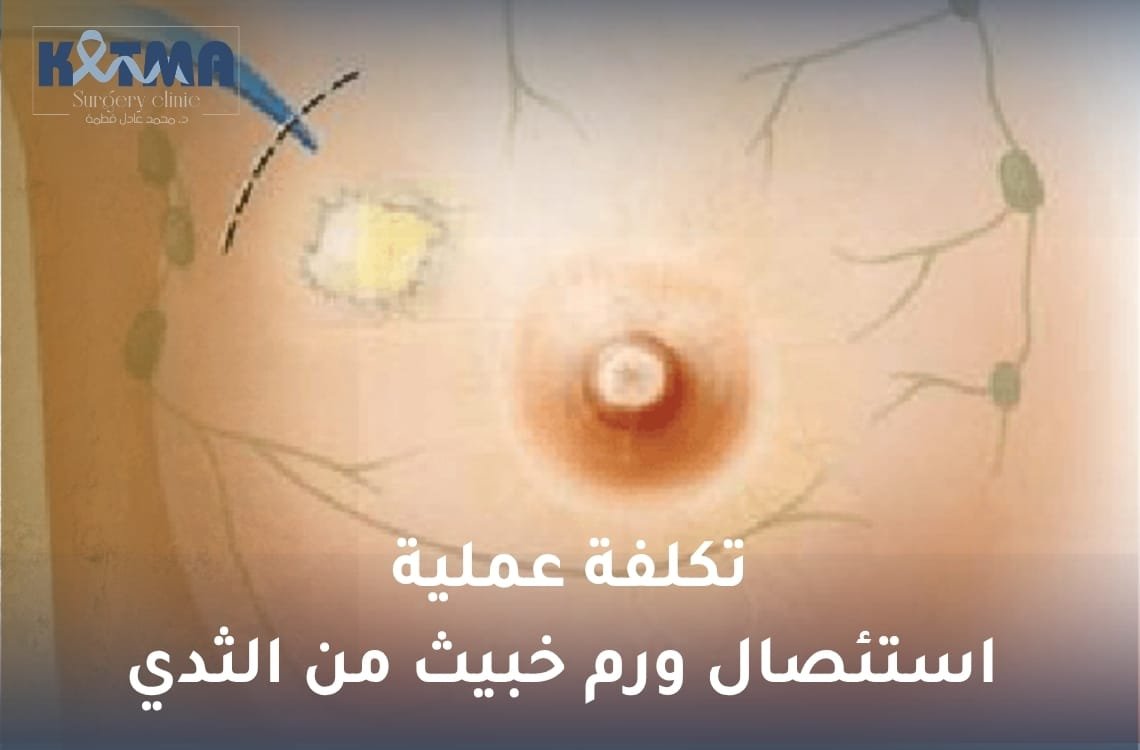 تكلفة عملية استئصال ورم خبيث من الثدي