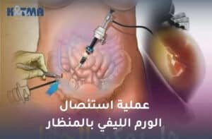 عملية استئصال الورم الليفي بالمنظار