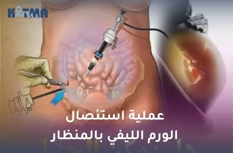عملية استئصال الورم الليفي بالمنظار