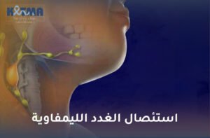 استئصال الغدد الليمفاوية