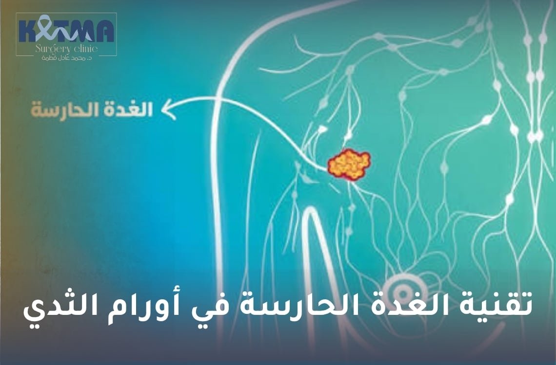 تقنية الغدة الحارسة في أورام الثدي