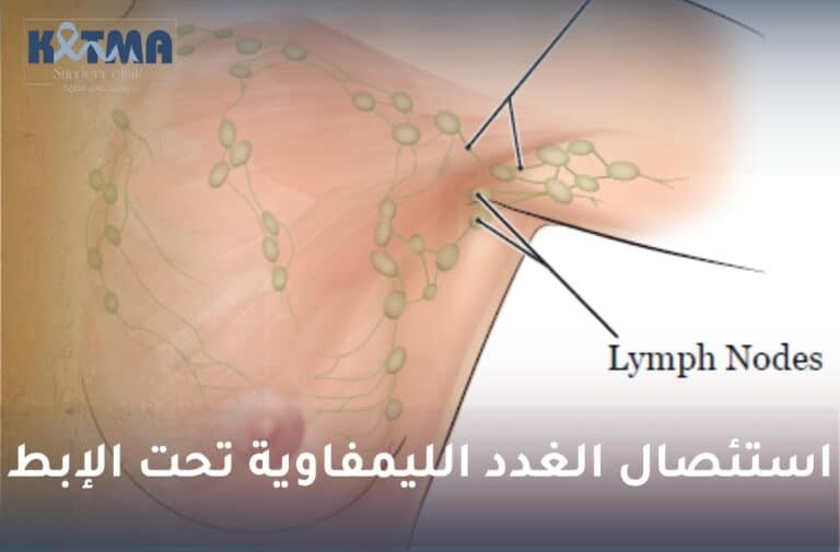 استئصال الغدد الليمفاوية تحت الإبط