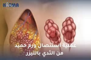 عملية استئصال ورم حميد من الثدي بالليزر