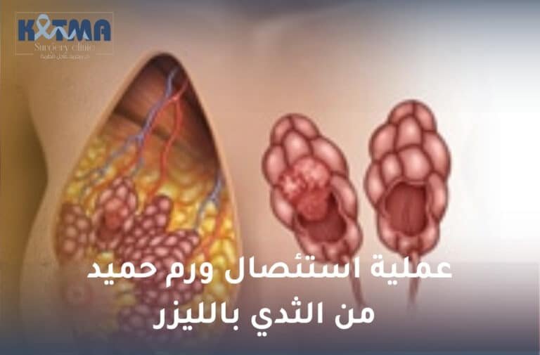 عملية استئصال ورم حميد من الثدي بالليزر