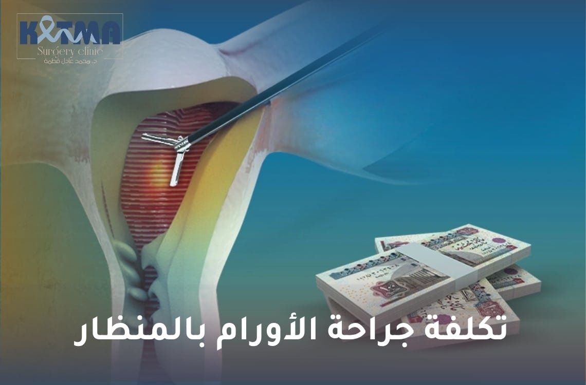 تكلفة جراحة الأورام بالمنظار