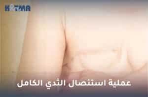 عملية استئصال الثدي الكامل