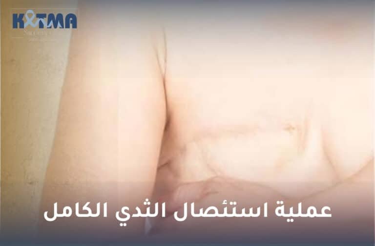عملية استئصال الثدي الكامل