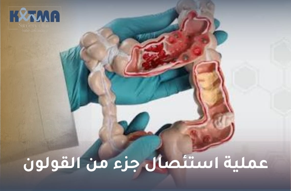 عملية استئصال جزء من القولون