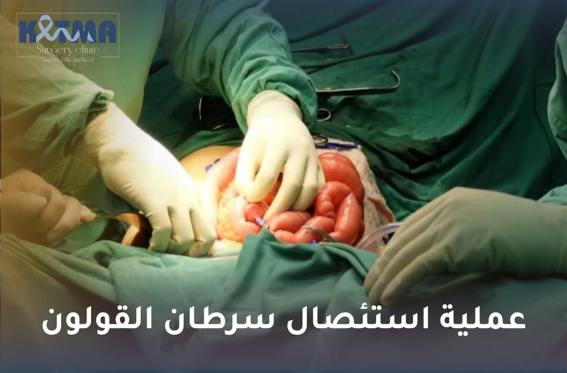 عملية استئصال سرطان القولون