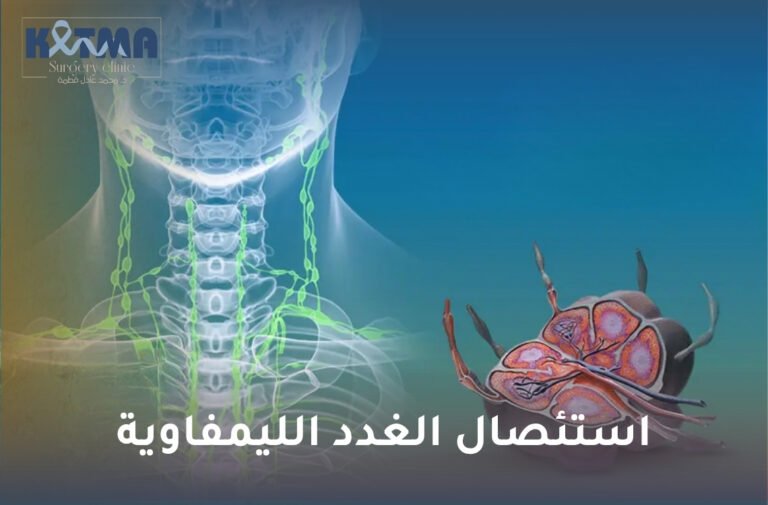استئصال الغدد الليمفاوية