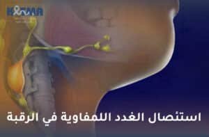 استئصال الغدد اللمفاوية في الرقبة