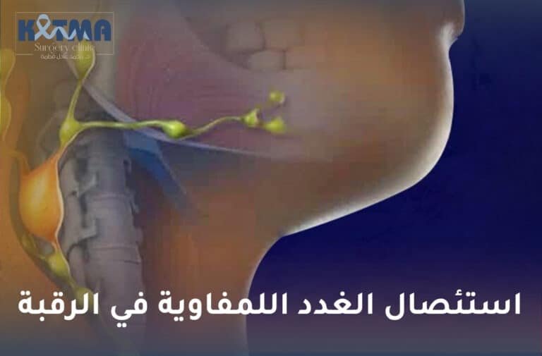 استئصال الغدد اللمفاوية في الرقبة