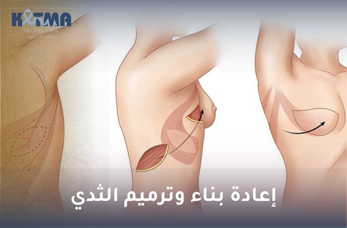 إعادة بناء وترميم الثدي