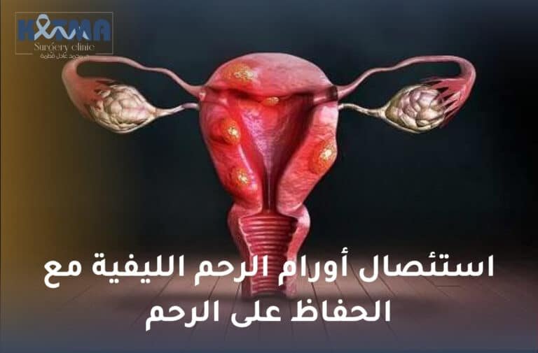 استئصال أورام الرحم الليفية مع الحفاظ على الرحم