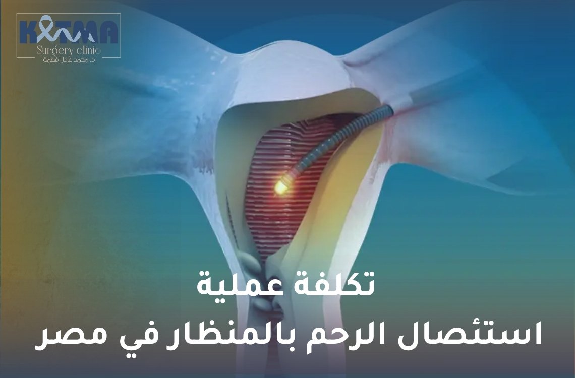 استئصال الرحم بالمنظار في مصر