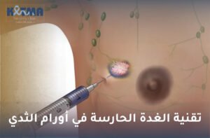 تقنية الغدة الحارسة في أورام الثدي