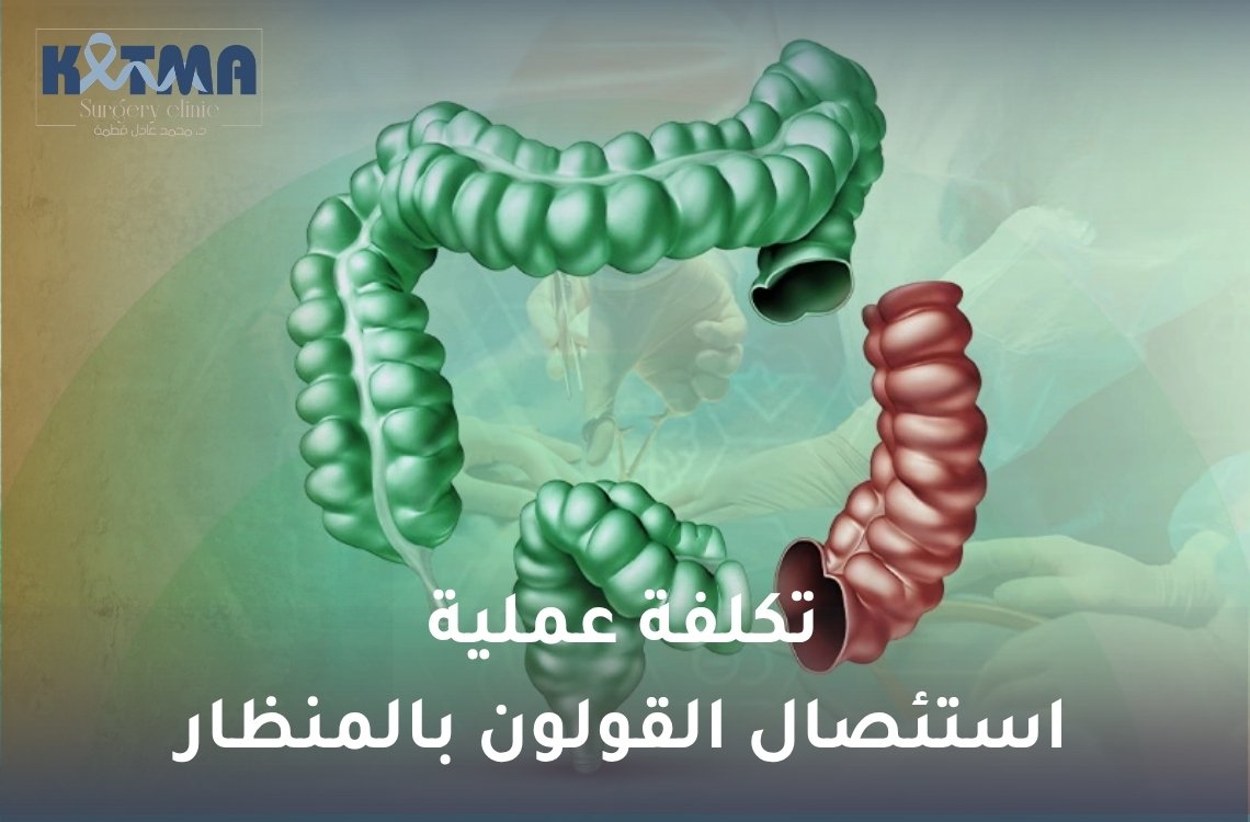 تكلفة عملية استئصال القولون بالمنظار