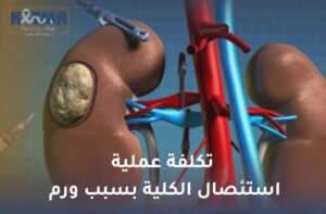 تكلفة عملية استئصال الكلية بسبب ورم