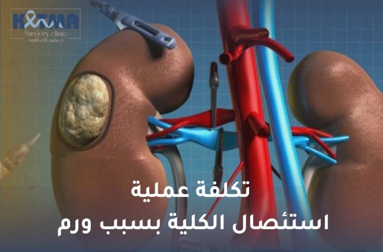 تكلفة عملية استئصال الكلية بسبب ورم