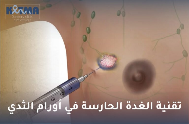 تقنية الغدة الحارسة في أورام الثدي