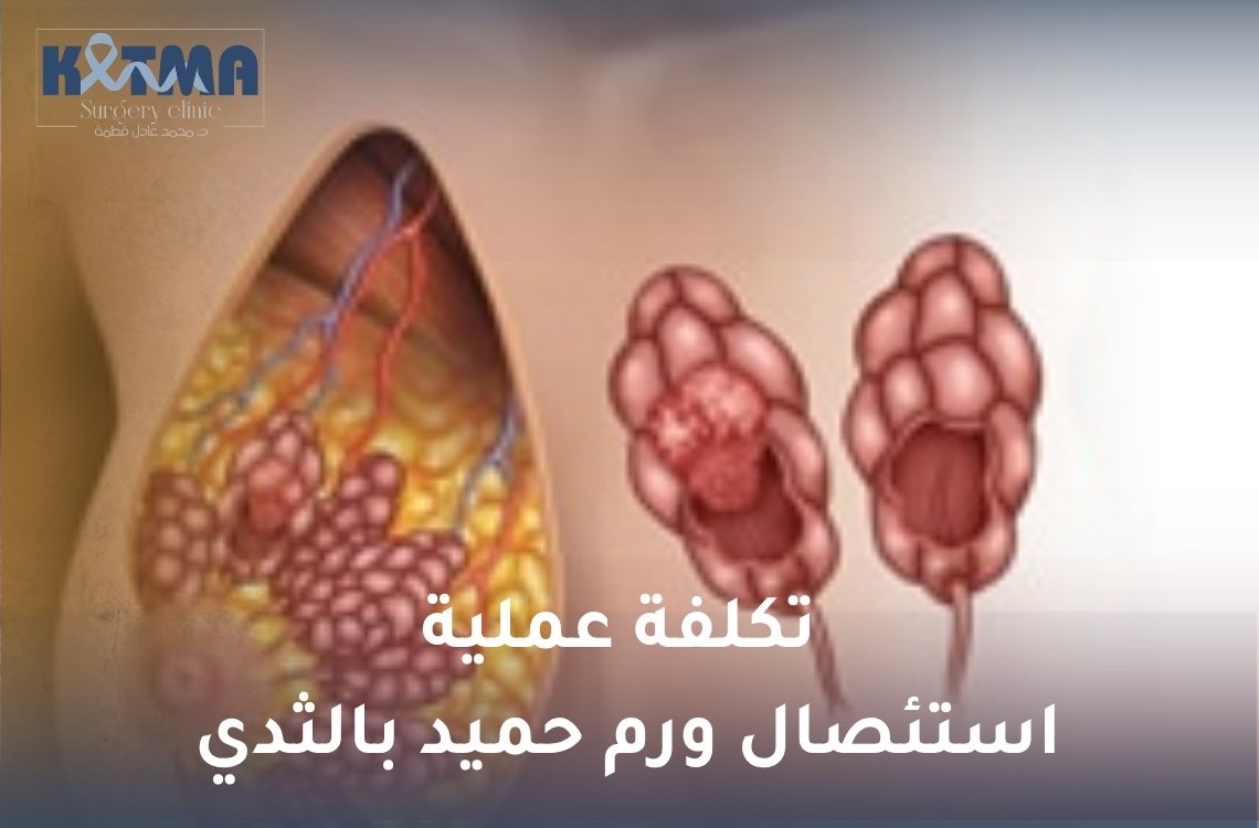 تكلفة عملية استئصال ورم حميد بالثدي