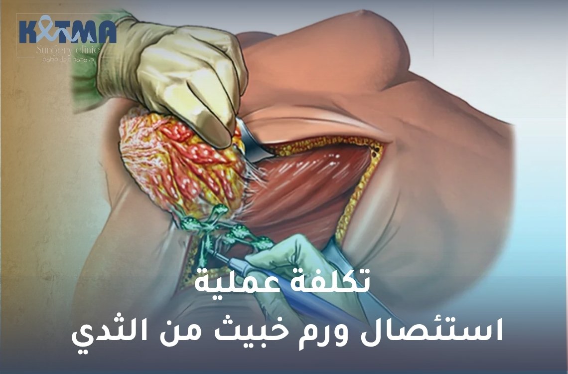 تكلفة عملية استئصال ورم خبيث من الثدي