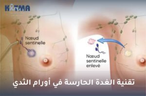 تقنية الغدة الحارسة في أورام الثدي