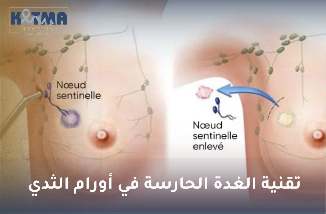 تقنية الغدة الحارسة في أورام الثدي