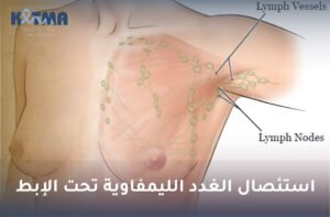 استئصال الغدد الليمفاوية تحت الإبط