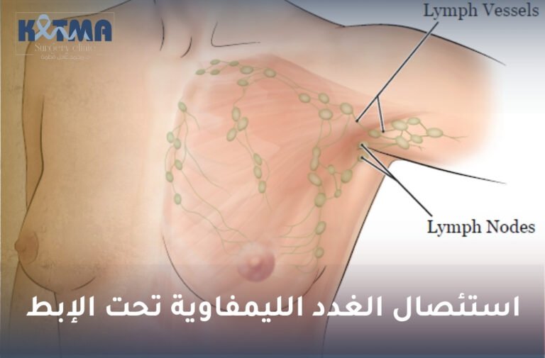 استئصال الغدد الليمفاوية تحت الإبط