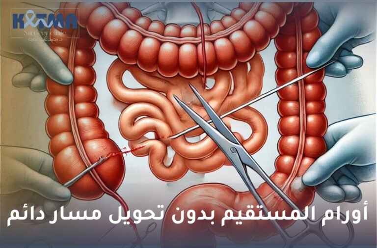 أورام المستقيم بدون تحويل مسار دائم