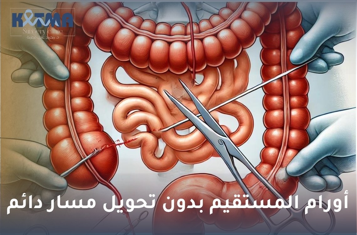 أورام المستقيم بدون تحويل مسار دائم