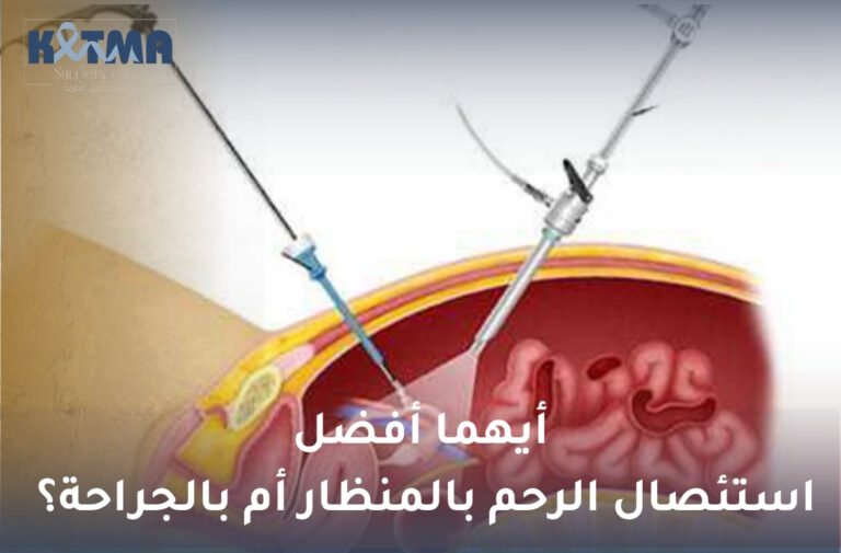 استئصال الرحم بالمنظار أم بالجراحة