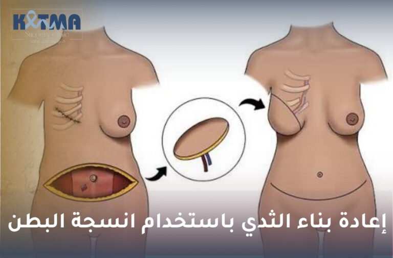 إعادة بناء الثدي باستخدام انسجة البطن