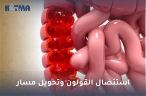 استئصال القولون وتحويل مسار
