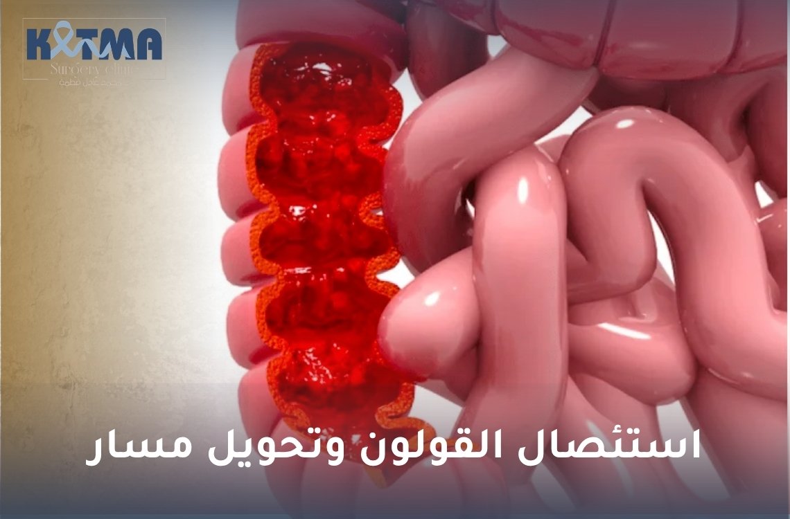 استئصال القولون وتحويل مسار