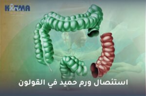 استئصال ورم حميد في القولون