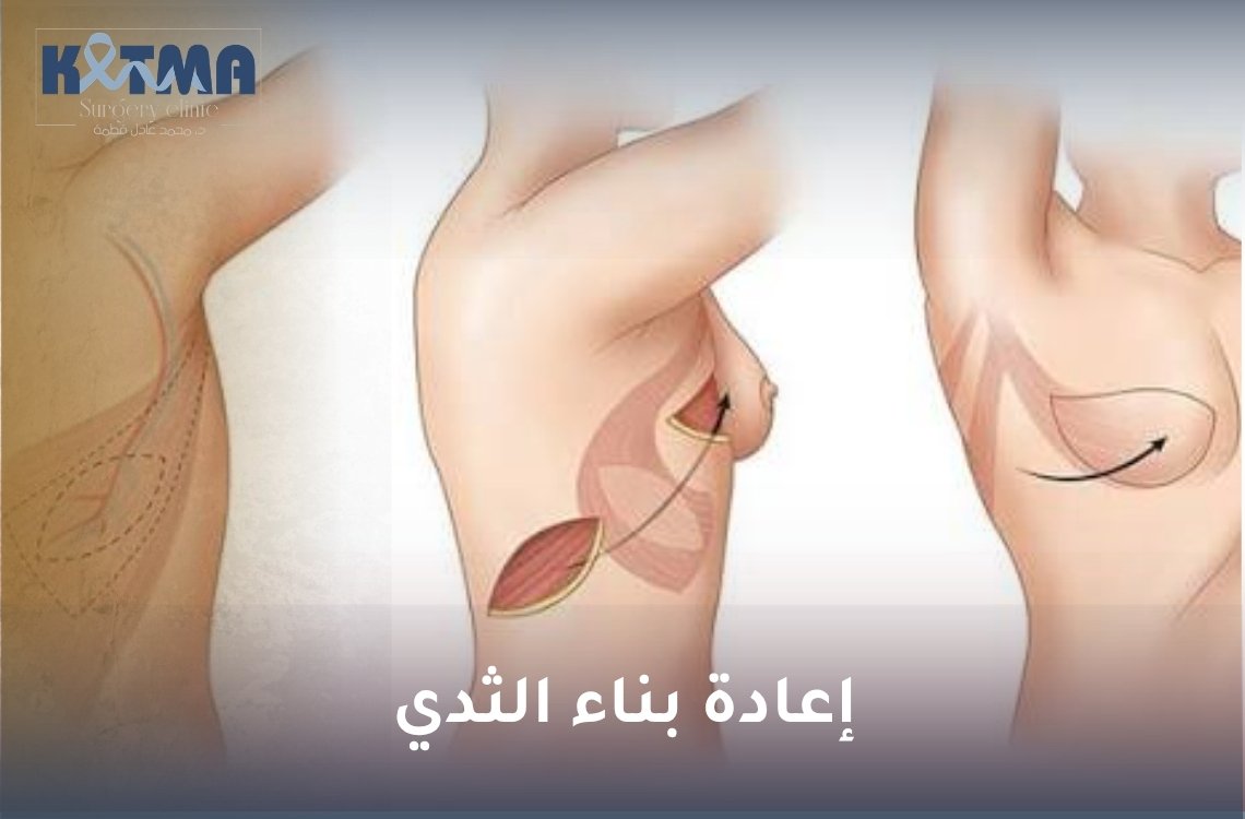 إعادة بناء الثدي
